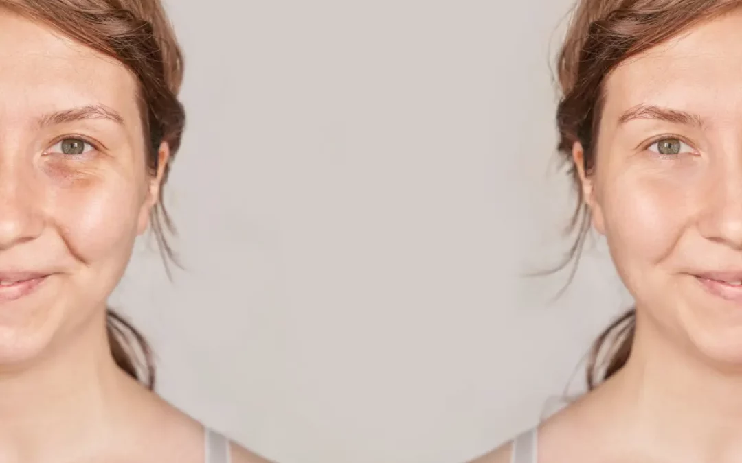 Profhilo Results In Aesthetic Practice: Witnessing Real-Life Transformations