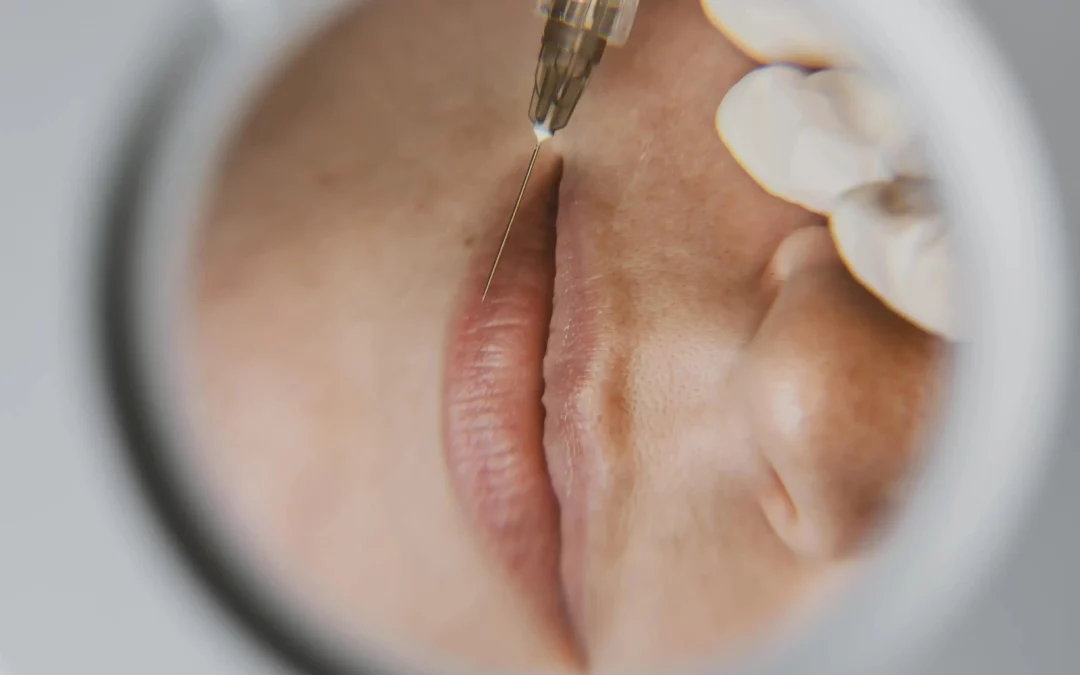 Saypha Lip Filler: Achieving Natural-Looking Lip Augmentation