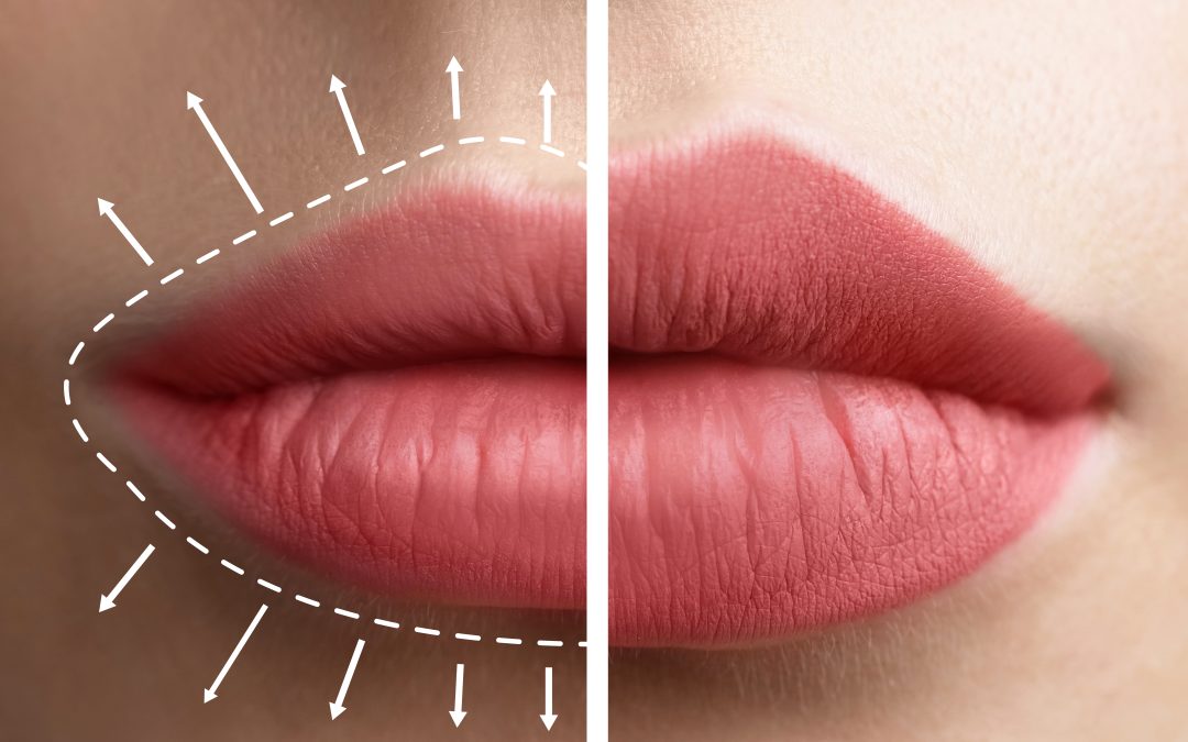 Aumento de labios con Revolax: Una guía completa