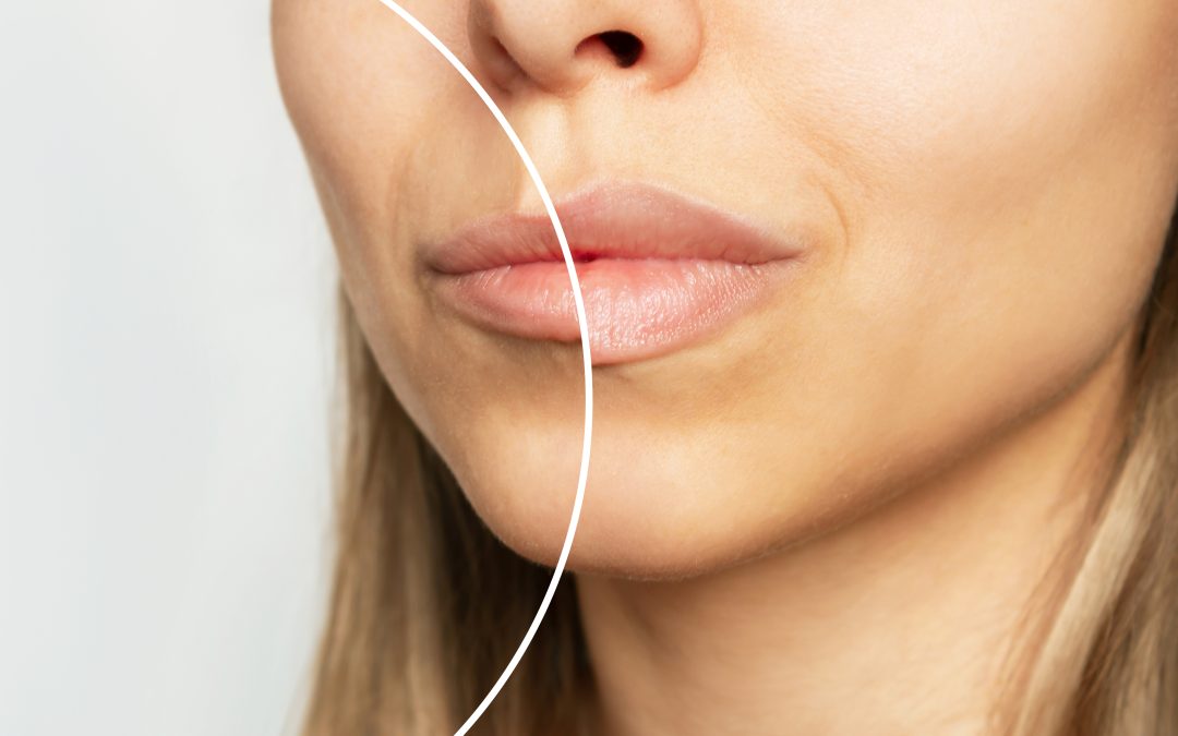 Saypha Filler Before and After: Examining Transformative Results